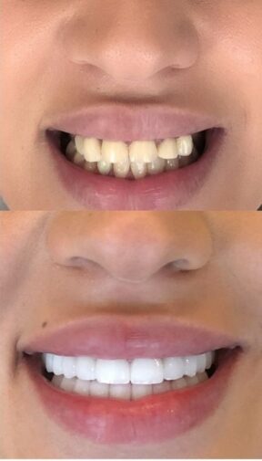 Before-and-after crown smile makeover showing a refined and natural-looking result - Sidus Dental