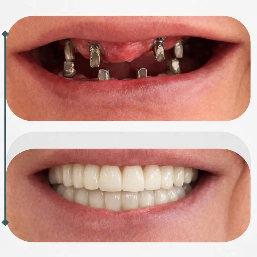 Before-and-after implant restoration case showing a full-smile result after treatment with Sidus Dental