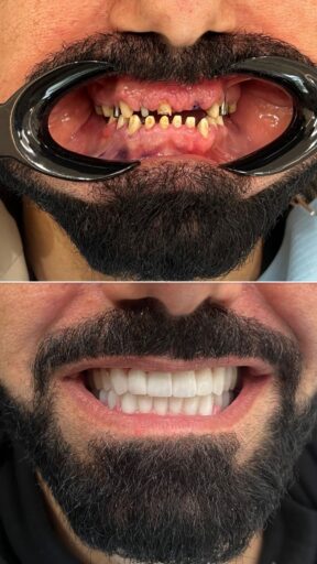 Before-and-after restored smile case showing clear improvement in the smile done with Sidus Dental