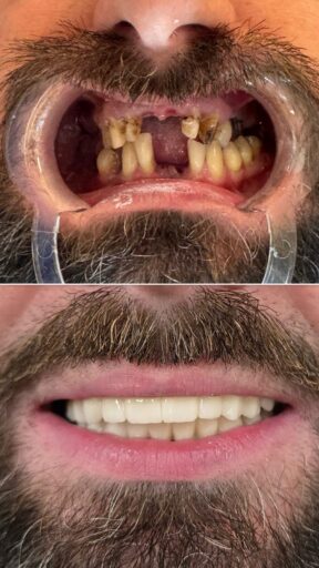 Before-and-after implant restoration showing missing teeth replaced with a restored smile, managed by Sidus Dental