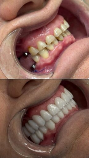 Hybrid restoration case showing a full-arch restored smile from a side view - Sidus Dental