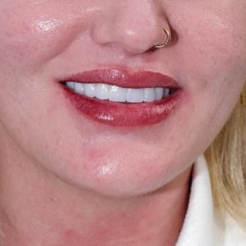 Close-up of smile improvement case with a clean and natural-looking finish. Dental treatment managed by Sidus Dental