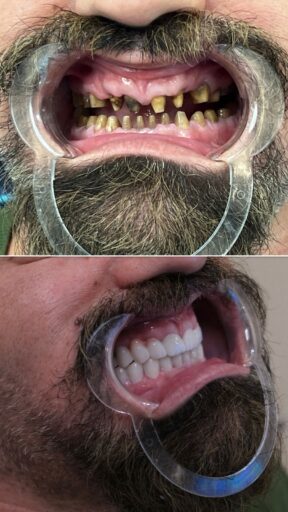 Before-and-after full mouth restoration showing restored upper and lower teeth managed by Sidus Dental team