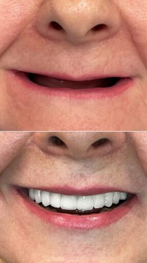 All-on-6 implant restoration showing a full-arch smile result with Sidus Dental