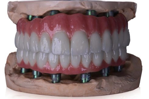 All-on-6 patient case managed by Sidus Dental in Albania