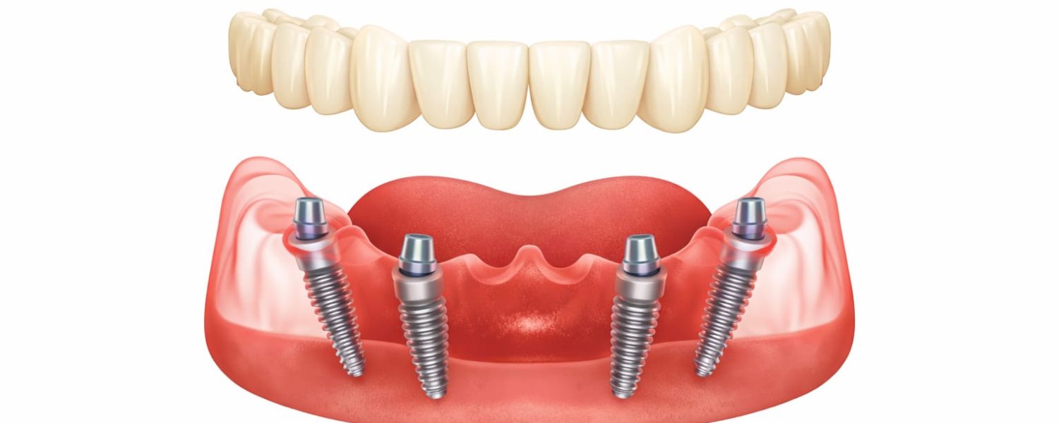 All-on-4 in Albania illustration showing a full-arch bridge supported by four implant