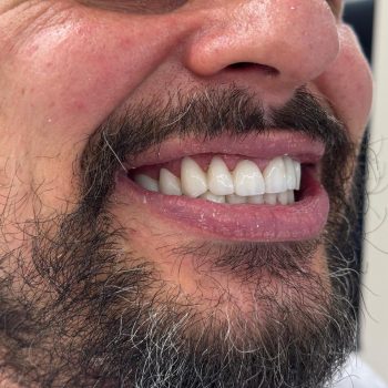 Side-view smile rehabilitation case showing natural aesthetics and a strong finish. Sidus Dental